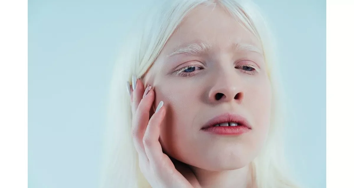 Kondisi Kulit Albino, Benarkah Penyakit Ini Bisa Menular?