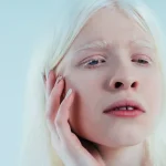 Kondisi Kulit Albino, Benarkah Penyakit Ini Bisa Menular?