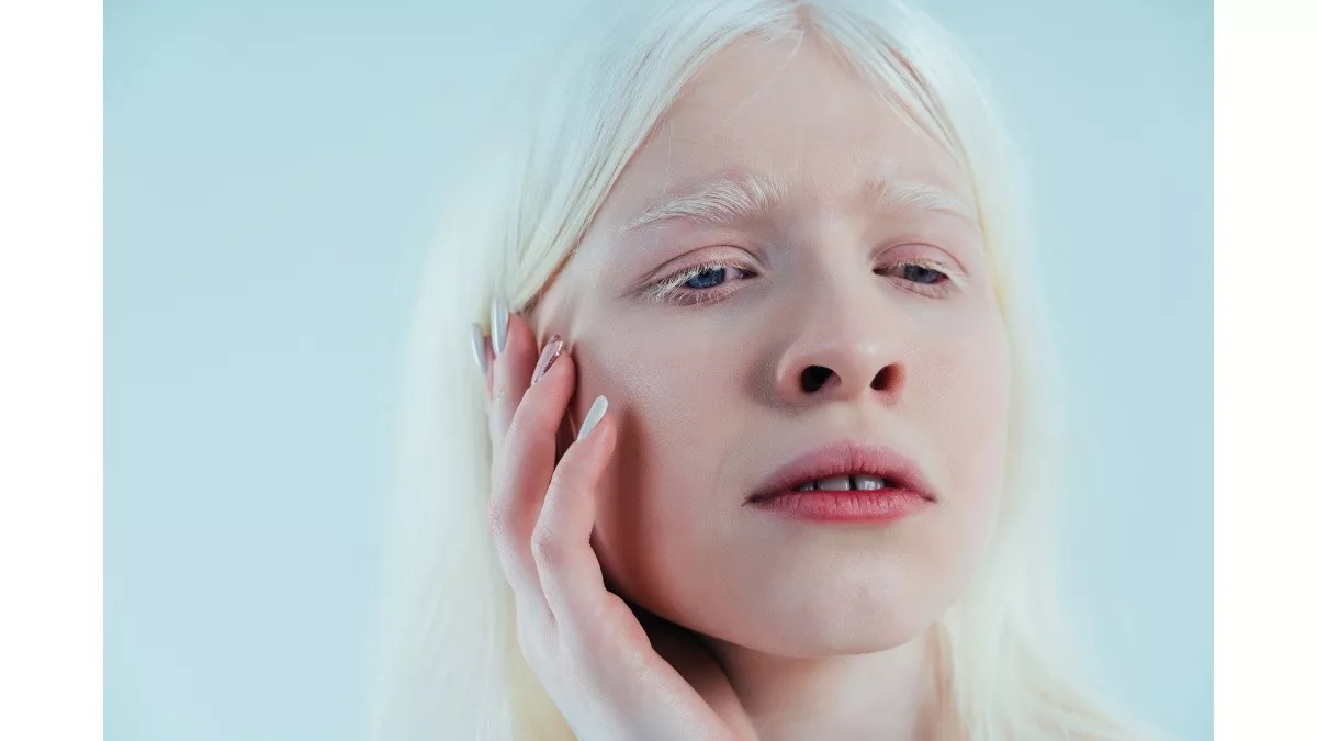 Kondisi Kulit Albino