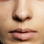 Warna Kulit Tidak Merata, Apa Penyebabnya & Cara Mengobatinya